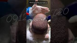 first headwash after hair transplant 😳 hairlosstreatment hairtransplantresults [upl. by Vullo]