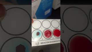 Blood Group 🩸💉AB negative blood group 🩸💉🧑‍🔬bloodtest lab motivation pathology dmlt bmlt [upl. by Notyal29]