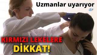 Vücudunuzda Hızlıca Yayılan Kırmızı Lekelere Dikkat [upl. by Asiat]