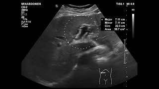 acute cholecystitis amp periportal halo [upl. by Anwahsak]