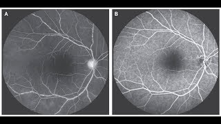 Vaskulitis der Retina bei Takayasu Arteriitis [upl. by Nored]