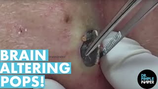 The POPS That Altered My Brain Chemistry 20 Minutes Dr Pimple Popper Best Of [upl. by Ymme]