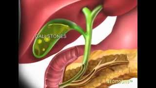 Acute Cholecystitis Gallbladder Attack Meditoons™ [upl. by Mctyre]