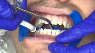 Bonding Invisalign attachments [upl. by Bouley53]