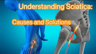 Understanding Sciatica  Causes and Solutions [upl. by Nosna]