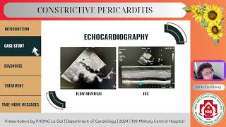 Constrictive pericarditis [upl. by Alvie]