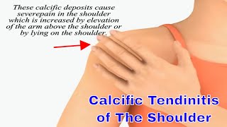 Calcific Tendinitis of the Shoulder Causes Symptoms and Effective Treatments [upl. by Ailaza]