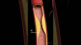 Atherosclerosis viralreels anatomy biology physiotharapist exercise doctorscience [upl. by Novoj962]