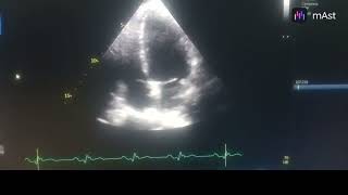 HYPOKINESIA OF INFEROLATERAL  INFERIOR WALL AND ANTEROLATERAL WALL MODERATE LV [upl. by Howe]