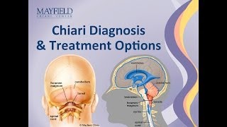 Chiari Malformation Diagnosis amp Treatment Options [upl. by Alfonzo]