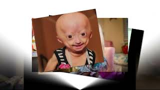 Youtuber Adalia Rose Texas star dies at 15 from rare medical condition [upl. by Danni]