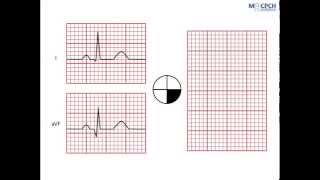 Working out the QRS axis on an ECG [upl. by Nylirad573]