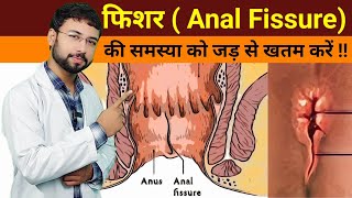 Fissure treatment at home hindi  Anal Fissure Home remedies  piles fistula fissure difference [upl. by Eelrebmyk733]