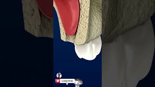 Sinus Lift Surgery  3D Animation [upl. by Nylanej55]