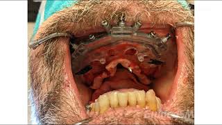 GuidedSMILE Dentate Maxilla Nobel FP3  Dr Fried [upl. by Prisilla]