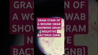 Gramnegative bacteria cause infections in wounds or surgical sites bacteremia mrsa esbl [upl. by Desmund]