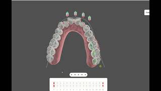 EXPANSION DentalMeshAIArchForm [upl. by Seabrooke]