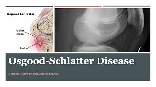 Osgood Schlatter Disease  A Minute Review [upl. by Brawley]