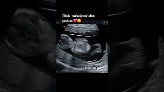 Baby movement in womb ultrasound pregnancy motherhood [upl. by Mallorie77]