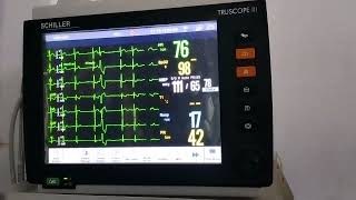 case of Ventricular Bigeminy changing to Trigeminy and Quadrigeminy [upl. by Assiralk]