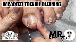 How to Fix Ingrown  Impacted Toenails at Home nails satisfying [upl. by Eenoj]