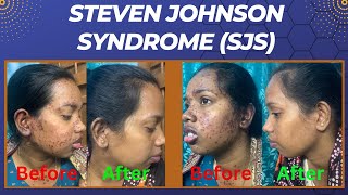 Stevens Johnson Syndrome  SJS  By Dr Uttam Kumar Lenka MBBS MD Consultant Dermatologist [upl. by Teodor]