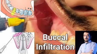 Local Anesthesia Buccal Infiltration Technique Maxillary Anesthesia Techniques dentistry [upl. by Yanel]