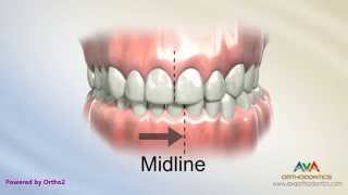 Orthodontic Treatment for Narrow Upper Jaw with Functional Shift  Expander or Spacer [upl. by Alfeus]