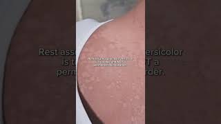 Pityriasis Versicolor What You Need to Know [upl. by Dilisio378]