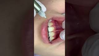 Infiltration anesthesia of the central incisors  Инфильтрационная анестезия центральных резцов [upl. by Huber662]