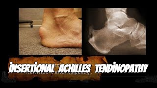 Why Achilles Tendinopathy Happens and How to Fix It [upl. by Robbins]