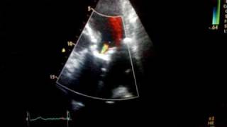 Aortic regurgitation combined with stenosis Ultrasound echocardiography [upl. by Airtemed]