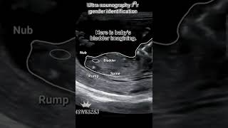 Baby Gender identification viralshort doctor ultrasoundscansscience [upl. by Veno757]