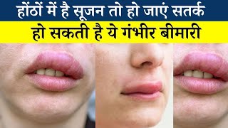 Angioedema cause and treatment होठों और आंखों की सूजन का इलाज [upl. by Neleh295]