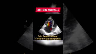 Ebstein Anomaly on Echocardiography [upl. by Haneen707]