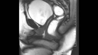 DEFECOGRAFIA RECTOCELE URETRA MG [upl. by Aenad]