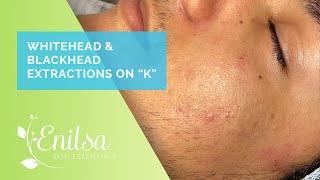 Enilsa is back Whitehead amp Blackhead Extractions on quotKquot  Part 1 [upl. by Acirej]