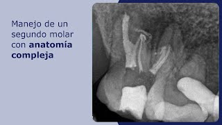 Manejo de un segundo molar con anatomía compleja [upl. by Sidney947]