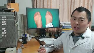 hallux valgus 青少年拇外翻怎么办？大陆哪里做拇趾外翻 [upl. by Don]