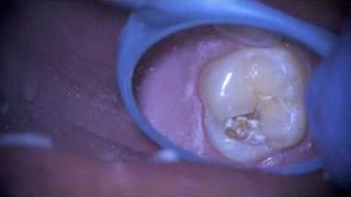 Dental Sealant Gone Bad [upl. by Cimbura]