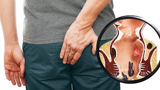 Natural Remedies for Hemorrhoids Effective Home Treatments and Tips for Fast Relief [upl. by Alys]