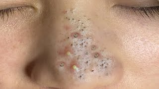 Big Cystic Acne Blackheads Extraction Blackheads amp Milia Whiteheads Removal Pimple Popping  5739 [upl. by Danni96]