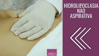 Hidrolipoclasia não Aspirativa Lipo Não Invasiva  Fisest [upl. by Azilef]