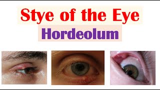 Eye Stye Hordeolum  Causes Symptoms Diagnosis amp At Home Treatments [upl. by Iviv426]