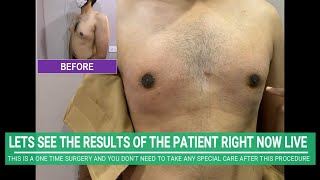 Gynecomastia Surgery Postop  Gynecomastia Surgery Recovery Time  Can you exercise after Surgery [upl. by Flower406]