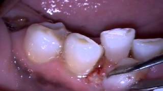 MD Epulis Removal [upl. by Otir]