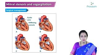 Mitral Stenosis amp Mitral Regurgitation Hindi  Internal Medicine🫀🫀🫀 [upl. by Brina19]