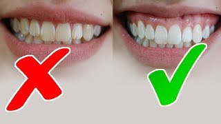 Amazing Ways to Remove for White Spots from on Teeth at Home Cures [upl. by Fransen]