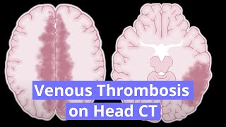 Venous Thrombosis on Head CT [upl. by Nrojb187]