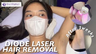 DIODE LASER HAIR REMOVAL  SKINSTATION 1st Session [upl. by Orling]